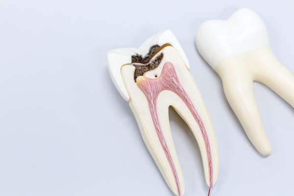 Ask a General Dentist: Is a Tooth Dead After a Root Canal from West Loop Smile Studio in Chicago, IL