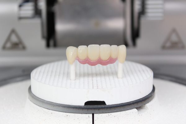 What Is A Porcelain Fixed Bridge?