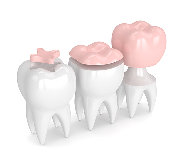 Chicago Dental Inlays and Onlays