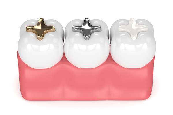 A General Dentist Discusses Different Filling Options from West Loop Smile Studio in Chicago, IL
