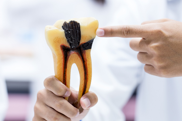 Root Canal Vs  Extraction: Make The Right Choice For Your Oral Health